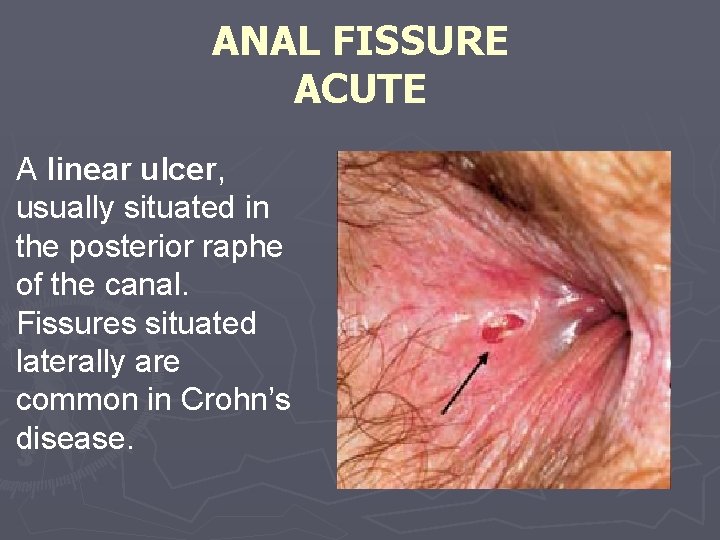 ANAL FISSURE ACUTE A linear ulcer, usually situated in the posterior raphe of the