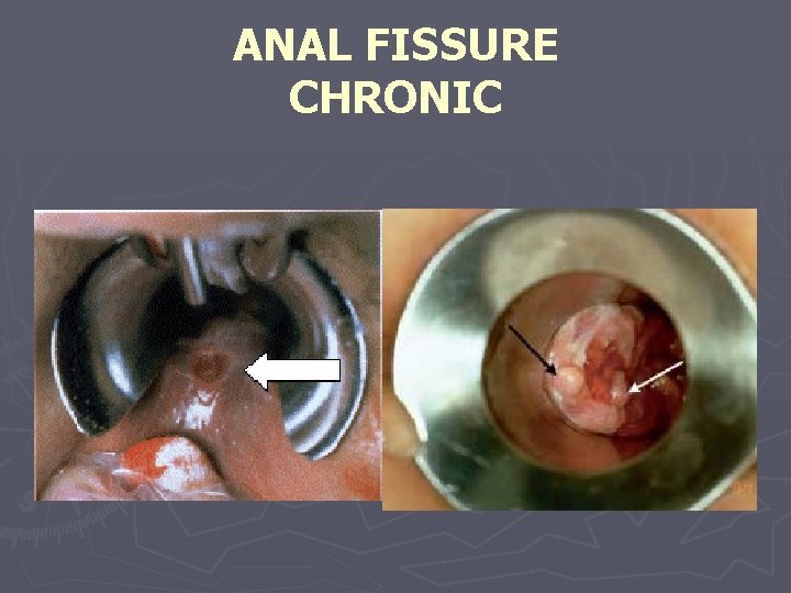 ANAL FISSURE CHRONIC 