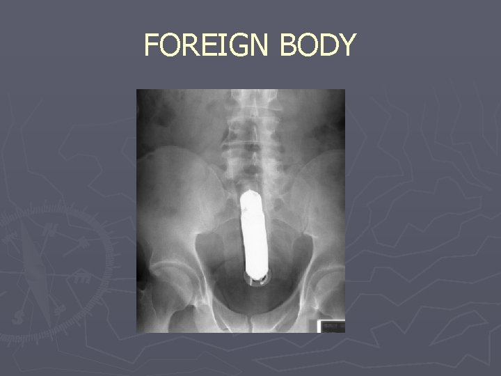 FOREIGN BODY 