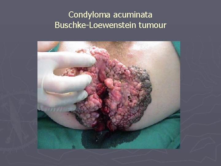 Condyloma acuminata Buschke-Loewenstein tumour 