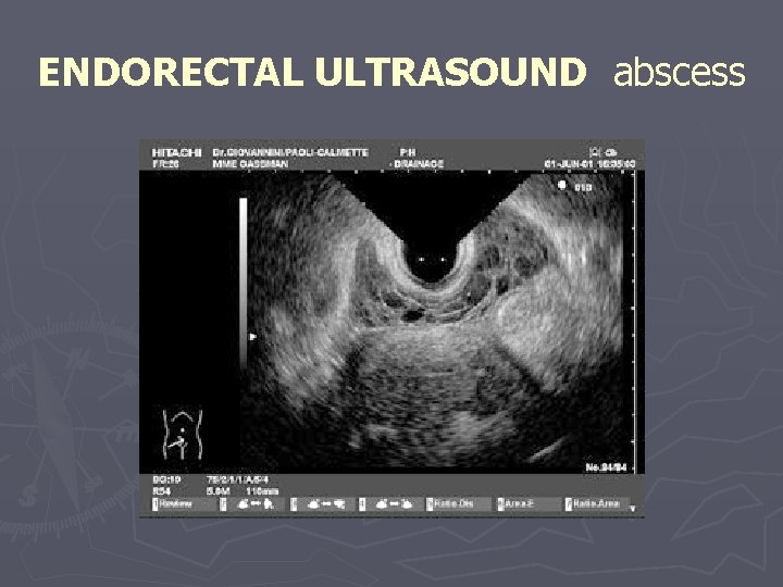 ENDORECTAL ULTRASOUND abscess 