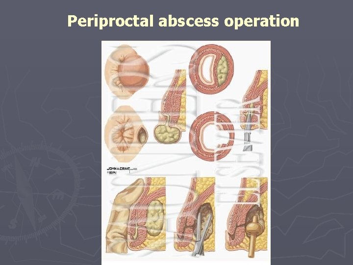 Periproctal abscess operation 