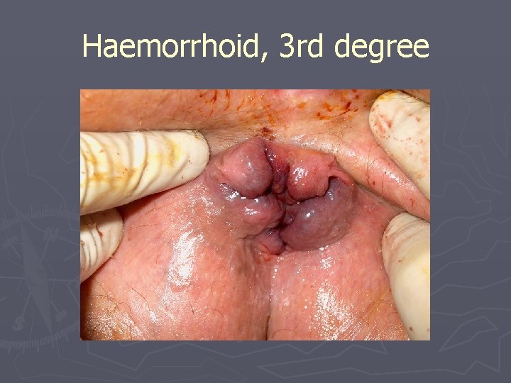 Haemorrhoid, 3 rd degree 