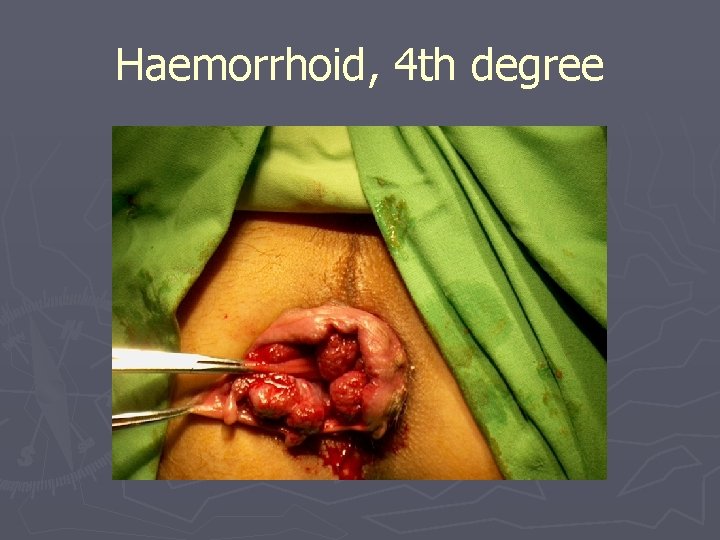 Haemorrhoid, 4 th degree 