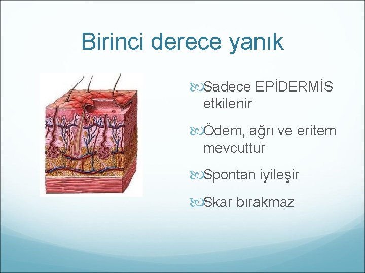 Birinci derece yanık Sadece EPİDERMİS etkilenir Ödem, ağrı ve eritem mevcuttur Spontan iyileşir Skar