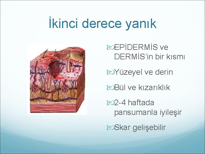 İkinci derece yanık EPİDERMİS ve DERMİS’in bir kısmı Yüzeyel ve derin Bül ve kızarıklık