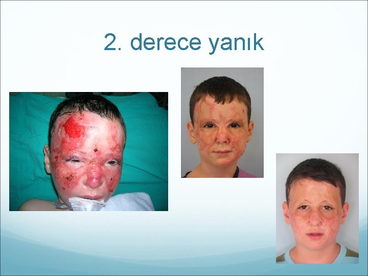 2. derece yanık 
