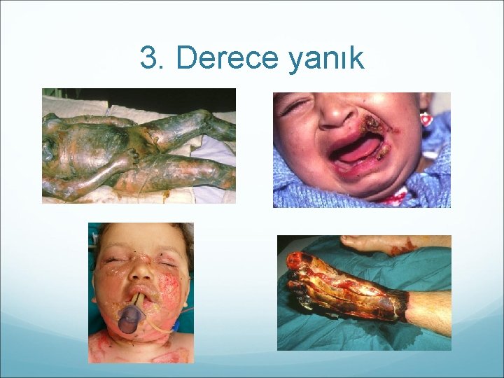 3. Derece yanık 