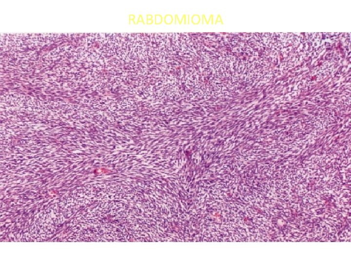 RABDOMIOMA 