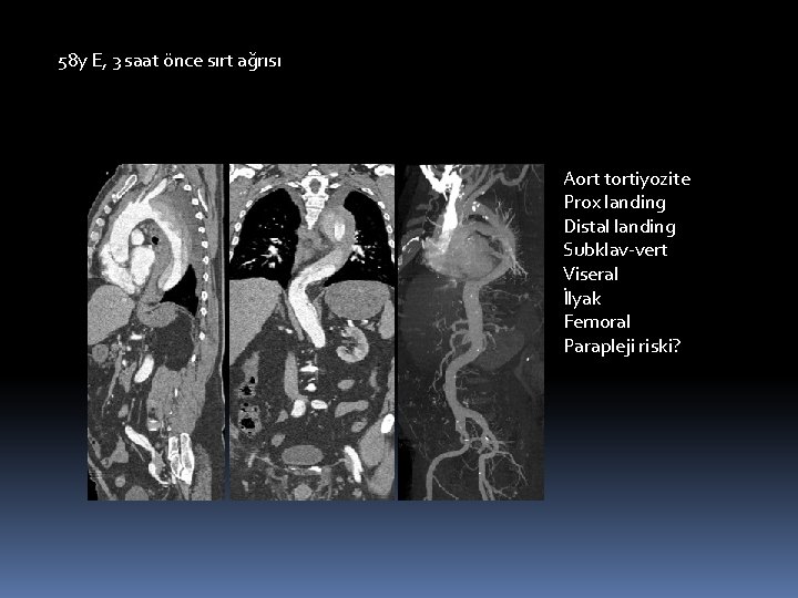 58 y E, 3 saat önce sırt ağrısı Aort tortiyozite Prox landing Distal landing