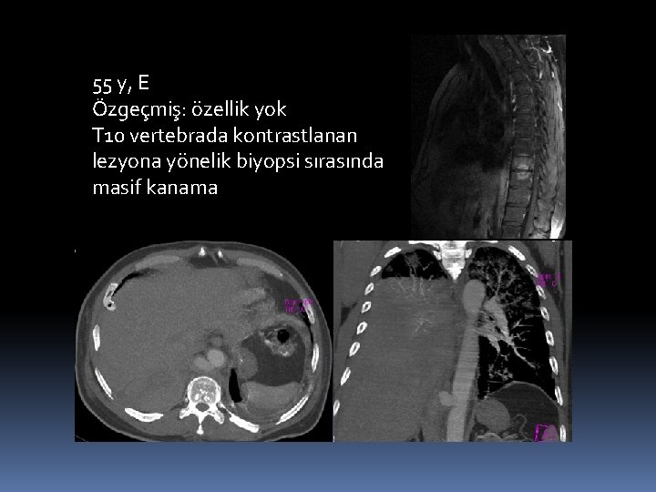 55 y, E Özgeçmiş: özellik yok T 10 vertebrada kontrastlanan lezyona yönelik biyopsi sırasında