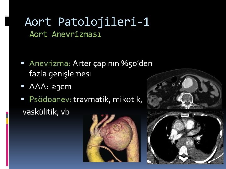 Aort Patolojileri-1 Aort Anevrizması Anevrizma: Arter çapının %50’den fazla genişlemesi AAA: ≥ 3 cm