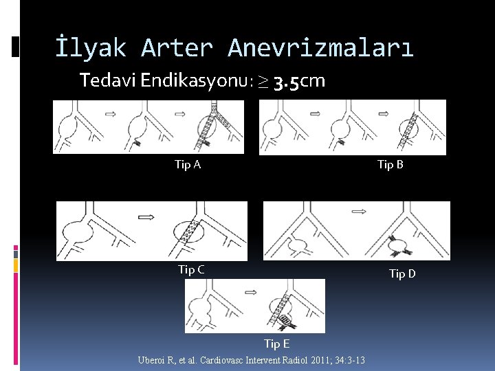 İlyak Arter Anevrizmaları Tedavi Endikasyonu: ≥ 3. 5 cm Tip A Tip B Tip