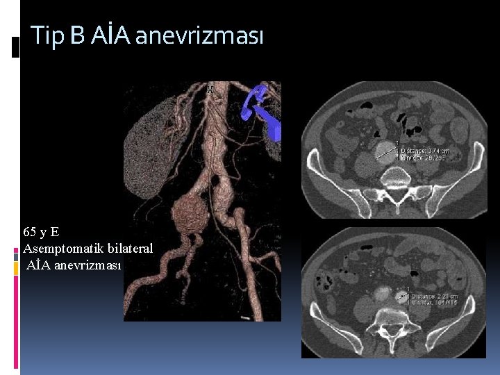 Tip B AİA anevrizması 65 y E Asemptomatik bilateral AİA anevrizması 