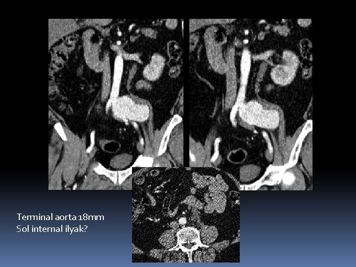 Terminal aorta 18 mm Sol internal ilyak? 