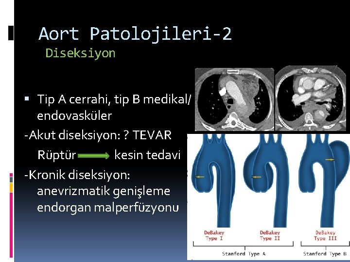Aort Patolojileri-2 Diseksiyon Tip A cerrahi, tip B medikal/ endovasküler -Akut diseksiyon: ? TEVAR