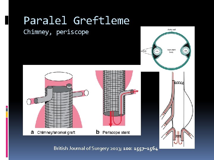 Paralel Greftleme Chimney, periscope British Journal of Surgery 2013; 100: 1557– 1564 