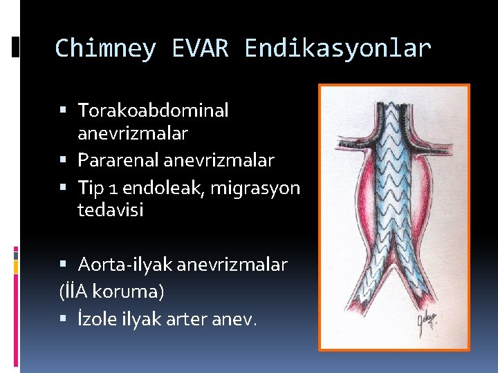 Chimney EVAR Endikasyonlar Torakoabdominal anevrizmalar Pararenal anevrizmalar Tip 1 endoleak, migrasyon tedavisi Aorta-ilyak anevrizmalar