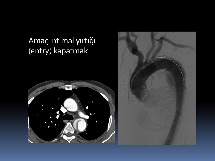 Amaç intimal yırtığı (entry) kapatmak 