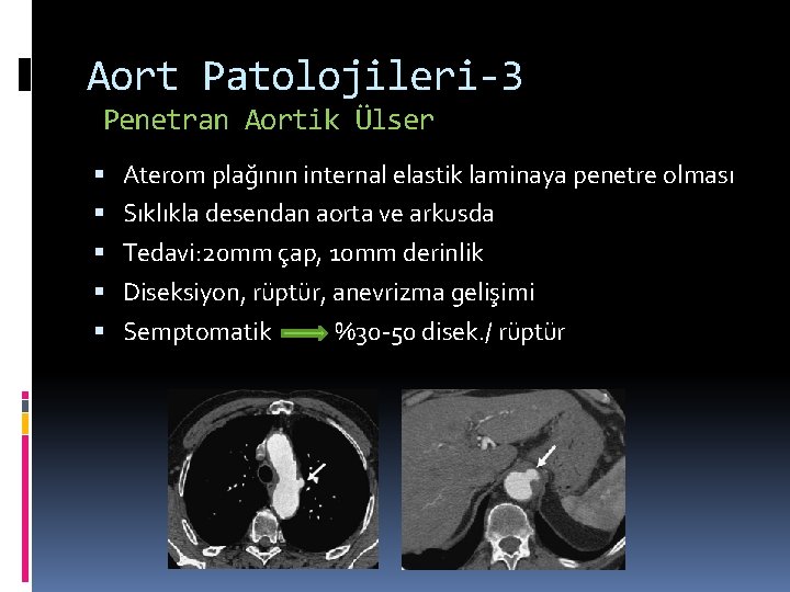 Aort Patolojileri-3 Penetran Aortik Ülser Aterom plağının internal elastik laminaya penetre olması Sıklıkla desendan