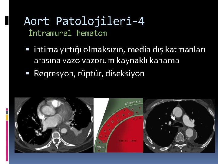 Aort Patolojileri-4 İntramural hematom intima yırtığı olmaksızın, media dış katmanları arasına vazorum kaynaklı kanama