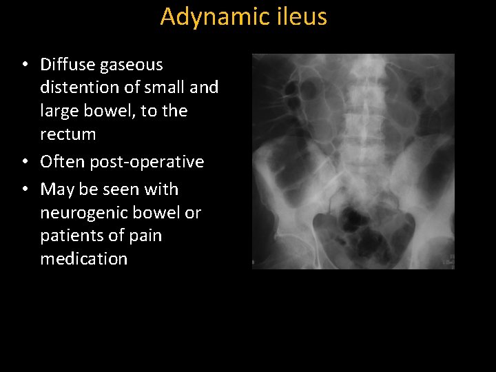 Adynamic ileus • Diffuse gaseous distention of small and large bowel, to the rectum