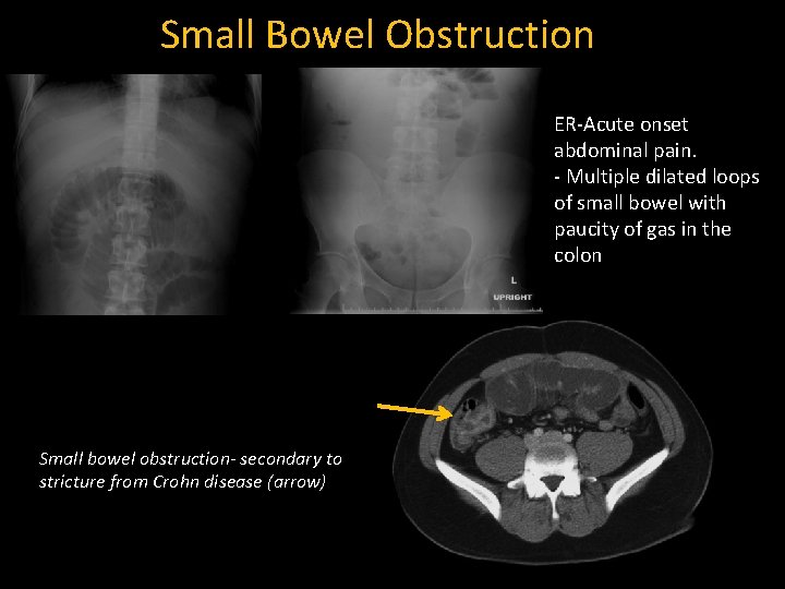 Small Bowel Obstruction ER-Acute onset abdominal pain. - Multiple dilated loops of small bowel