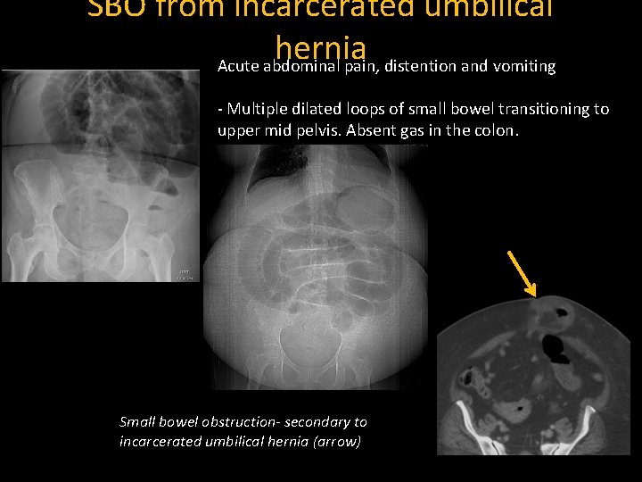 SBO from incarcerated umbilical hernia Acute abdominal pain, distention and vomiting - Multiple dilated