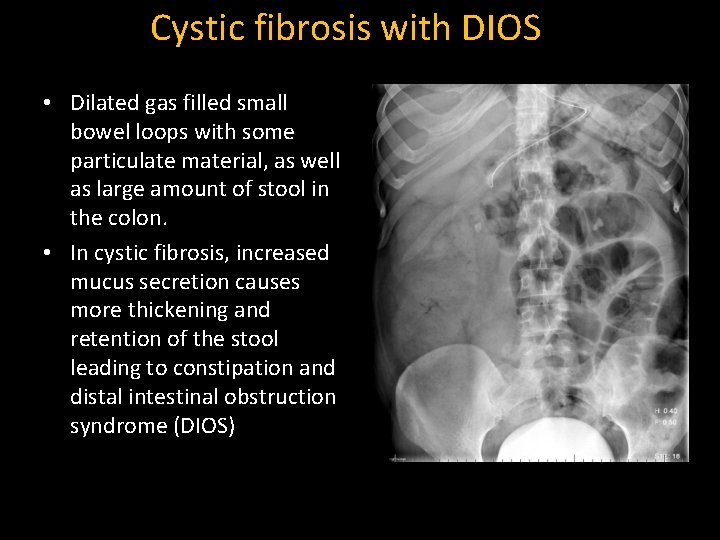 Cystic fibrosis with DIOS • Dilated gas filled small bowel loops with some particulate