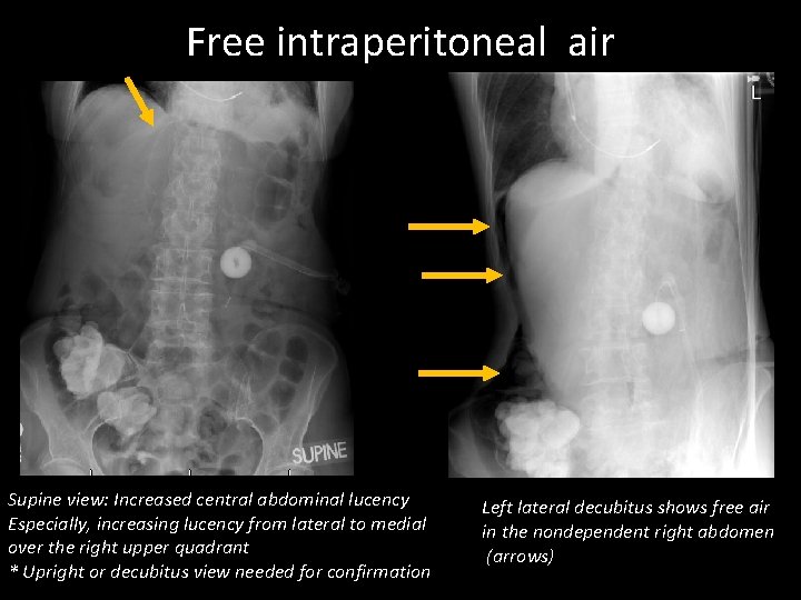 Free intraperitoneal air Supine view: Increased central abdominal lucency Especially, increasing lucency from lateral