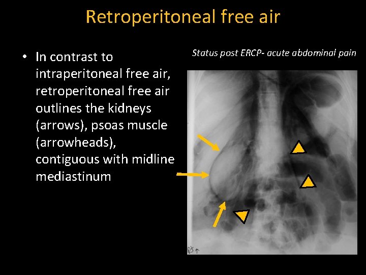 Retroperitoneal free air • In contrast to intraperitoneal free air, retroperitoneal free air outlines