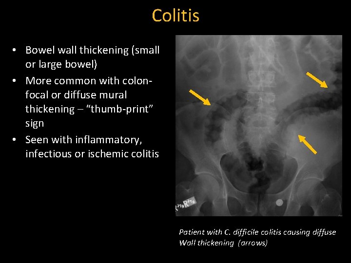 Colitis • Bowel wall thickening (small or large bowel) • More common with colonfocal
