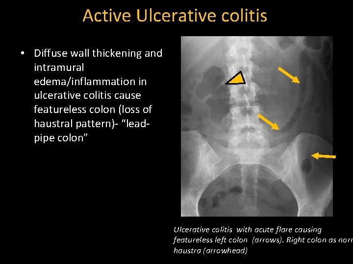 Active Ulcerative colitis • Diffuse wall thickening and intramural edema/inflammation in ulcerative colitis cause