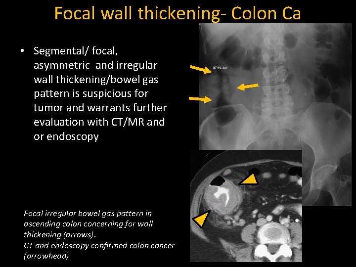 Focal wall thickening- Colon Ca • Segmental/ focal, asymmetric and irregular wall thickening/bowel gas