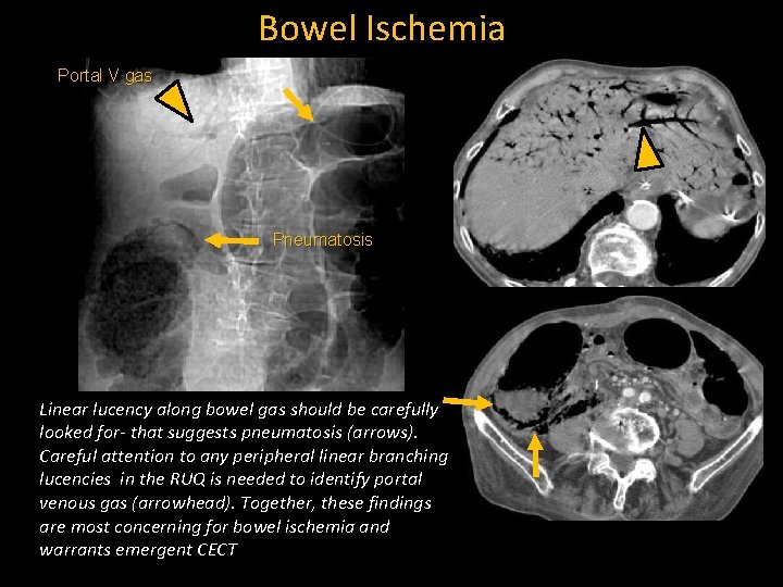 Bowel Ischemia Portal V gas Pneumatosis Linear lucency along bowel gas should be carefully
