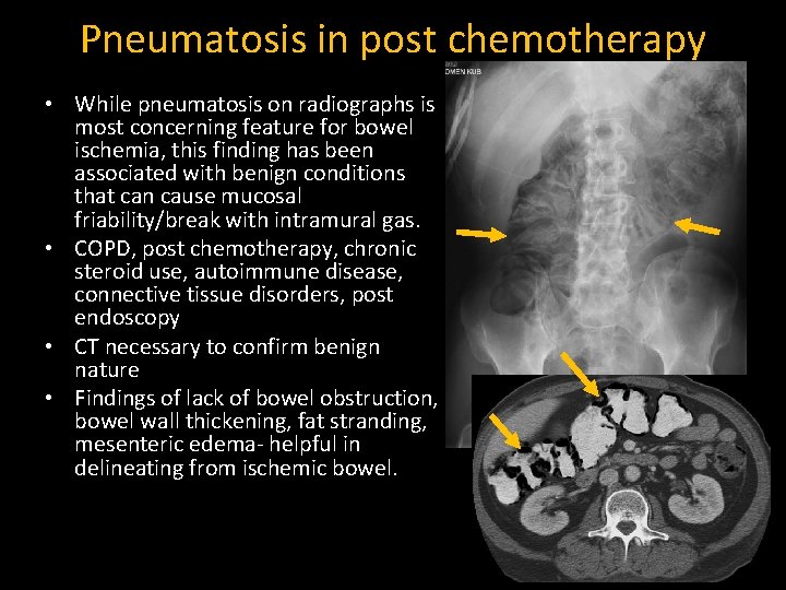 Pneumatosis in post chemotherapy • While pneumatosis on radiographs is most concerning feature for