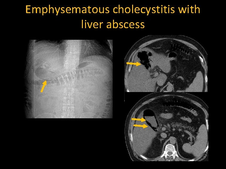 Emphysematous cholecystitis with liver abscess 
