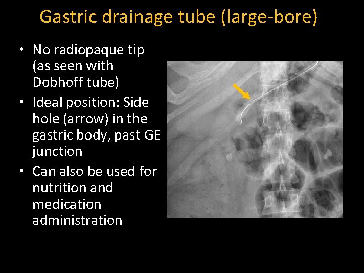 Gastric drainage tube (large-bore) • No radiopaque tip (as seen with Dobhoff tube) •