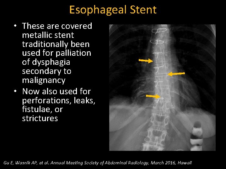 Esophageal Stent • These are covered metallic stent traditionally been used for palliation of