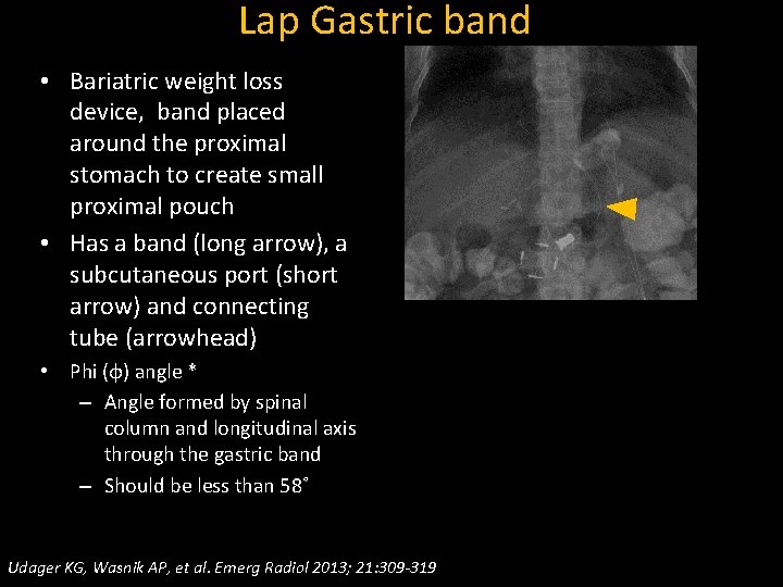 Lap Gastric band • Bariatric weight loss device, band placed around the proximal stomach