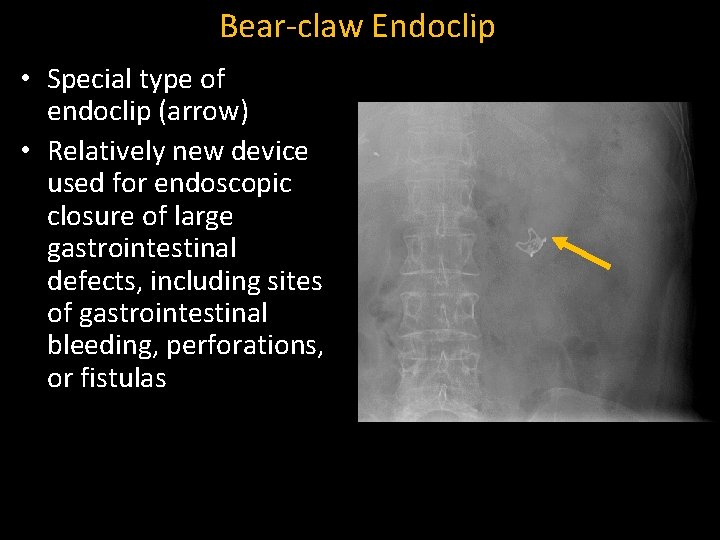 Bear-claw Endoclip • Special type of endoclip (arrow) • Relatively new device used for