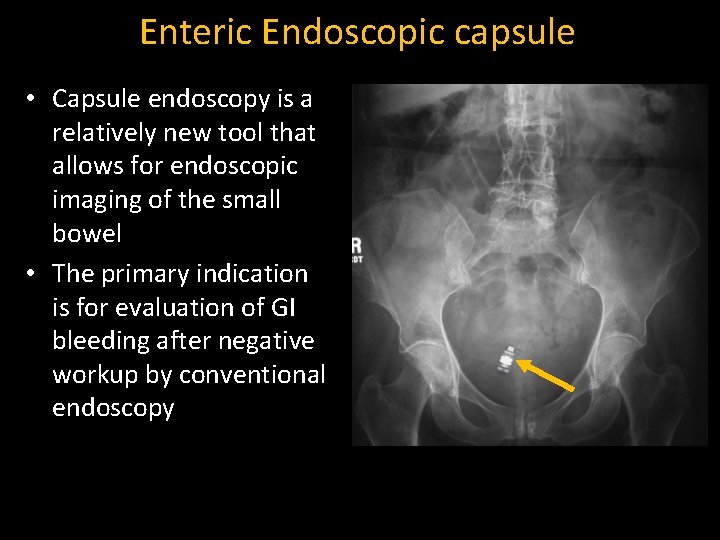 Enteric Endoscopic capsule • Capsule endoscopy is a relatively new tool that allows for