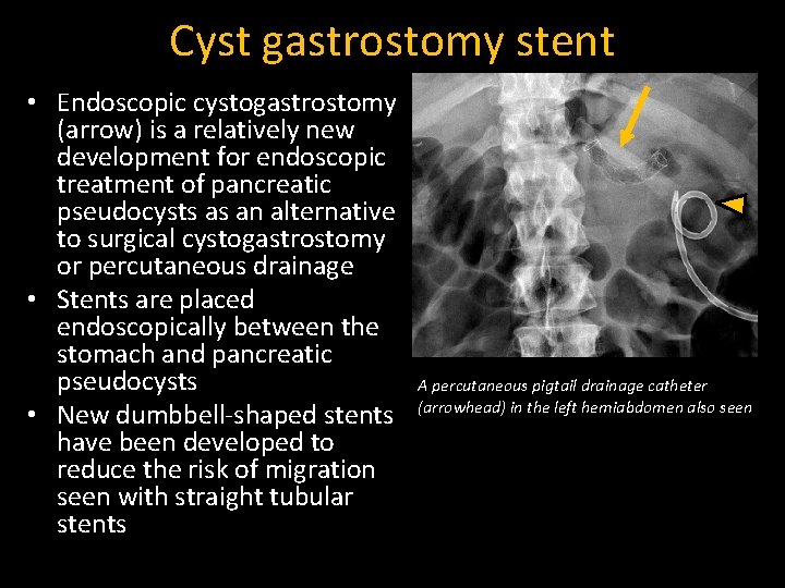 Cyst gastrostomy stent • Endoscopic cystogastrostomy (arrow) is a relatively new development for endoscopic