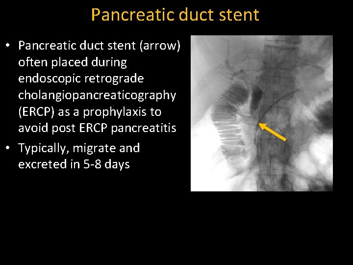 Pancreatic duct stent • Pancreatic duct stent (arrow) often placed during endoscopic retrograde cholangiopancreaticography