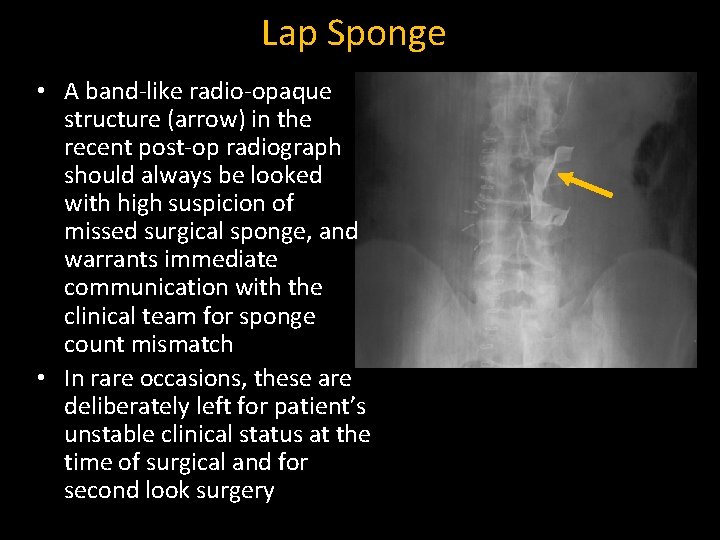 Lap Sponge • A band-like radio-opaque structure (arrow) in the recent post-op radiograph should