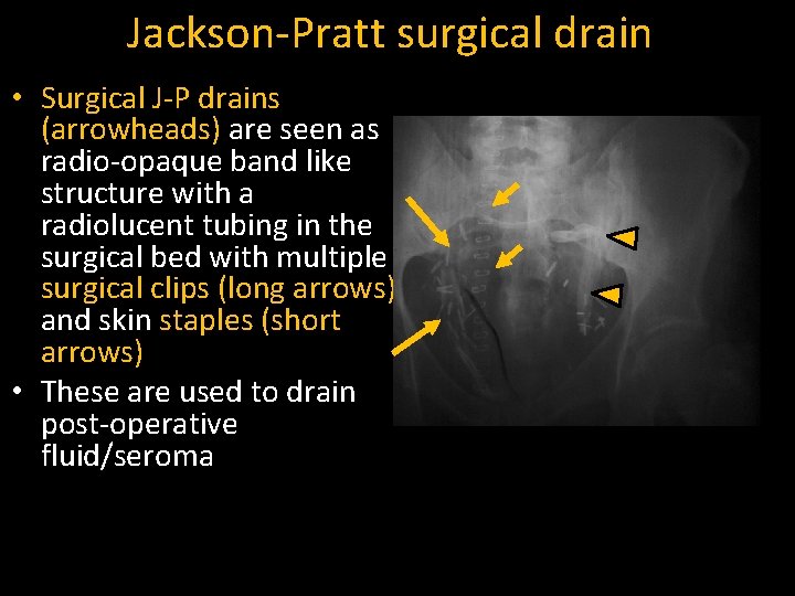Jackson-Pratt surgical drain • Surgical J-P drains (arrowheads) are seen as radio-opaque band like