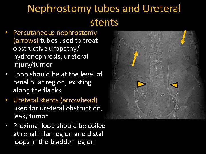 Nephrostomy tubes and Ureteral stents • Percutaneous nephrostomy (arrows) tubes used to treat obstructive
