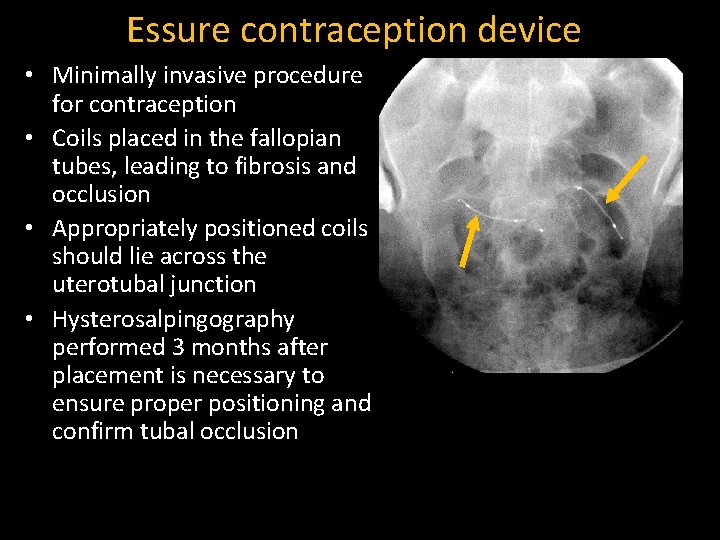 Essure contraception device • Minimally invasive procedure for contraception • Coils placed in the