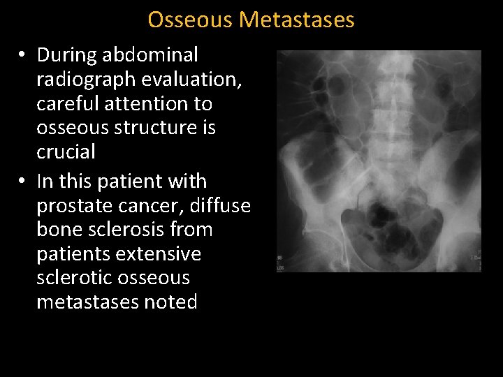 Osseous Metastases • During abdominal radiograph evaluation, careful attention to osseous structure is crucial
