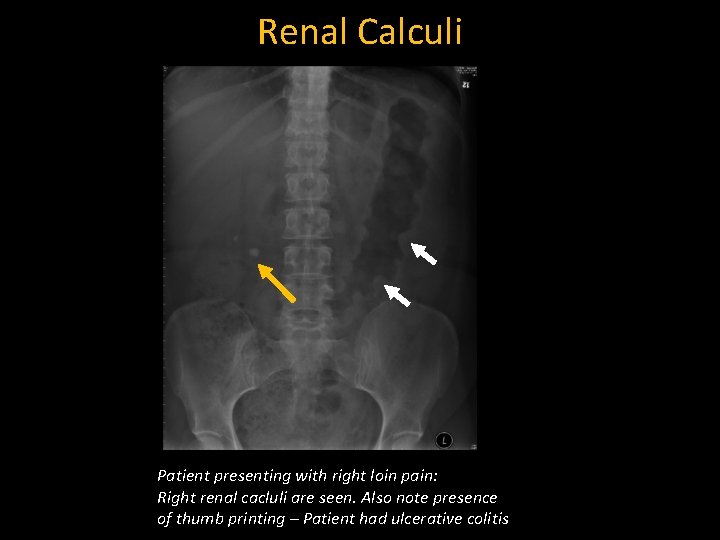 Renal Calculi Patient presenting with right loin pain: Right renal cacluli are seen. Also